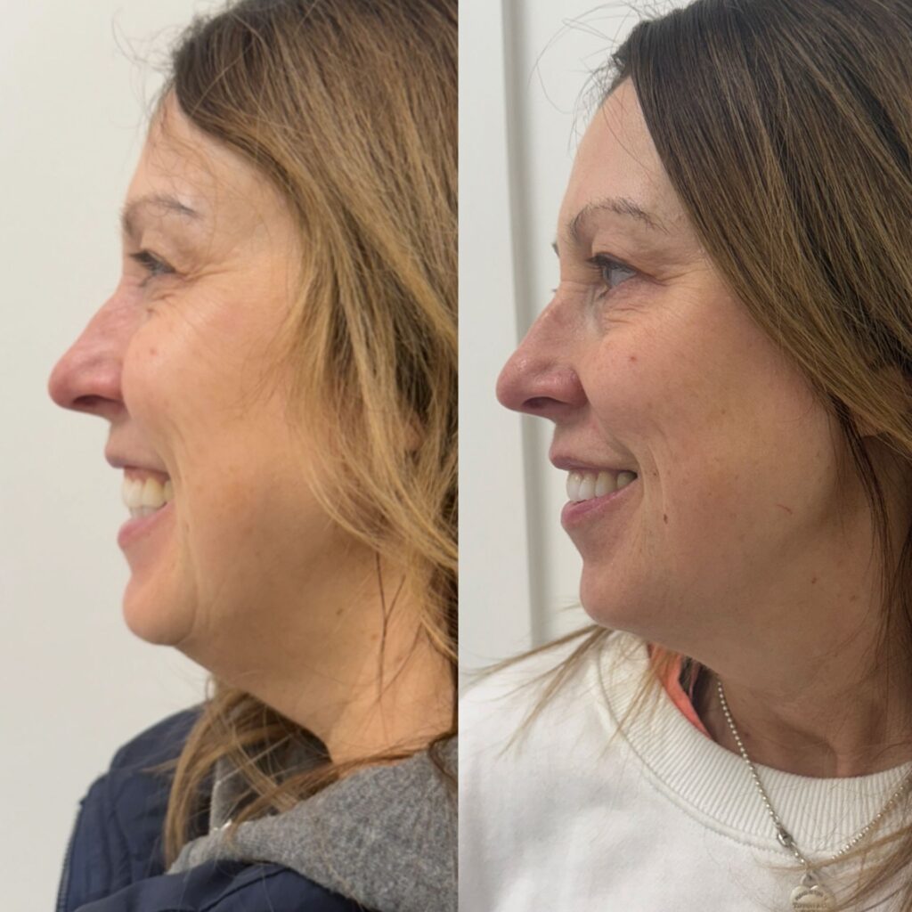 Sculptra Genuine Client Result